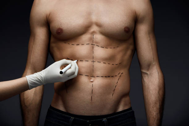 Lipo HD - Abdômen Masculino